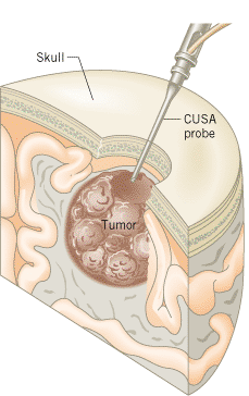 Neurosurgeons use a cavitron ultrasonic surgical aspirator (CUSA) to cut out brain tumors without adversely affecting the surrounding healthy tissue.
